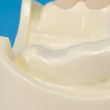 グラフト実習用顎模型 [P9-X.876]｜株式会社ニッシン｜歯科模型・歯科