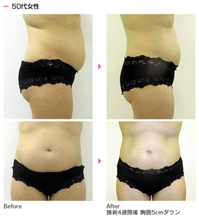 ライポソニックス（Liposonix）| ボディ・医療痩身｜北九州の美容外科