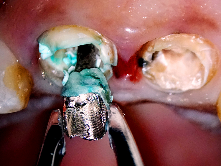 重度の歯根破折に対し、抜歯を回避して審美修復を行ったメタルフリー