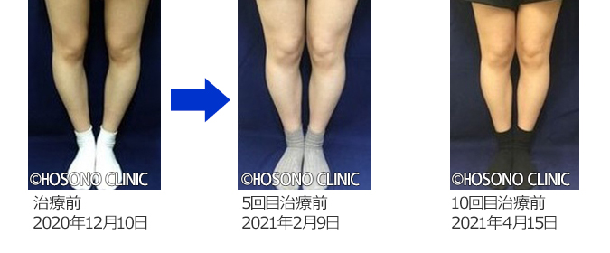 O脚・X脚治療プログラム-痛みの原因治療専門外来【細野クリニック