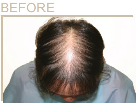 抜け毛・薄毛対策 発毛実感レディースプラン｜リーブ21の女性限定プラン