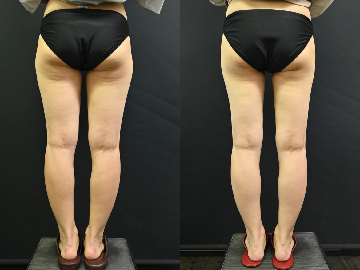 脂肪吸引のダウンタイム・圧迫・早く治す過ごし方【写真あり】 - 横浜院