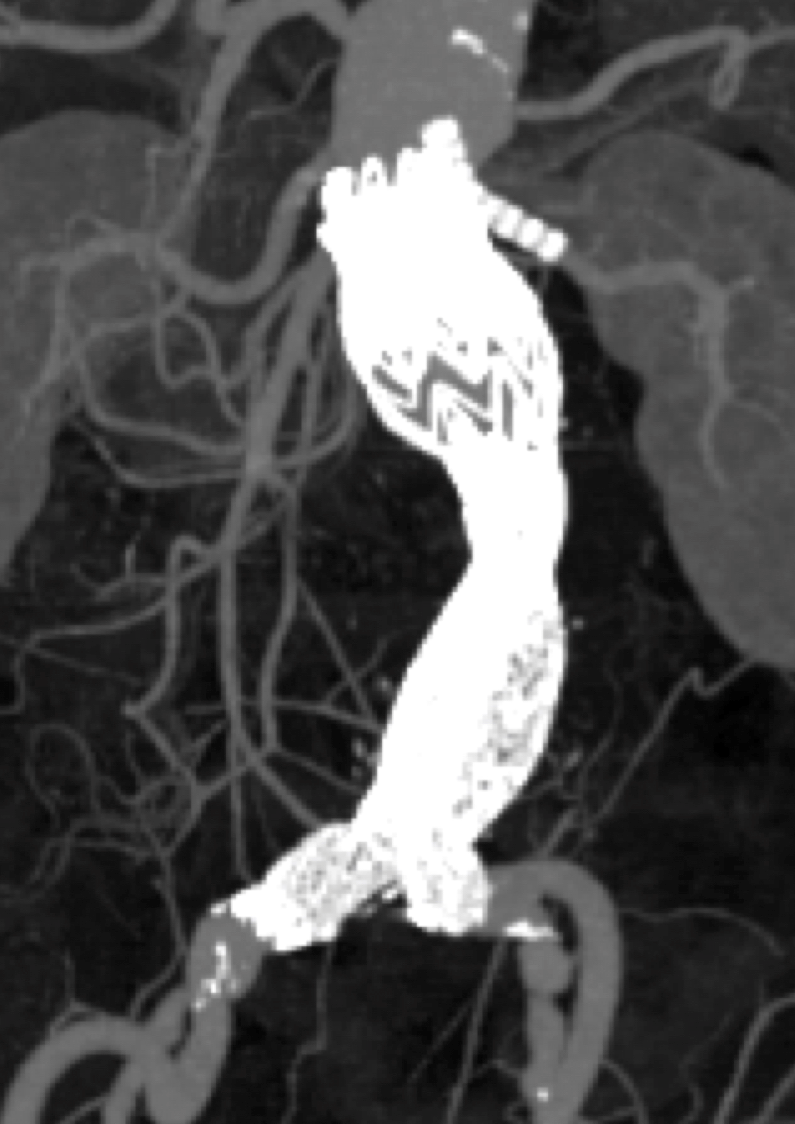 腹部大動脈瘤のステントグラフト内挿術｜診療科情報｜地方独立行政法人