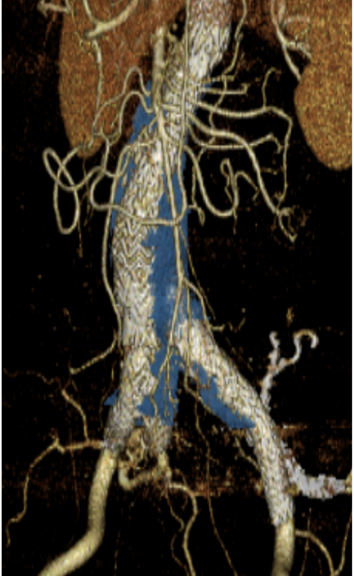 腹部大動脈瘤のステントグラフト内挿術｜診療科情報｜地方独立行政法人