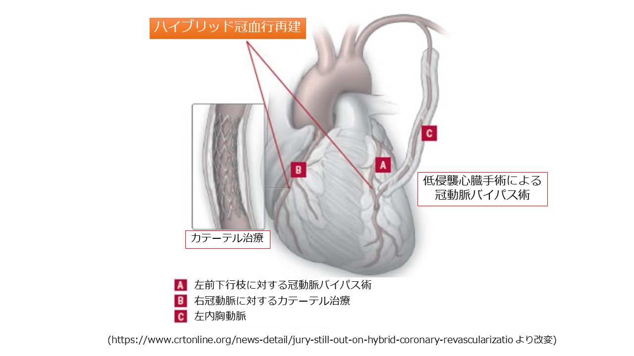 冠動脈バイパス術 | 東京科学大学 心臓血管外科