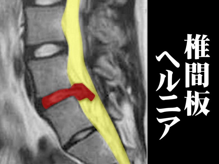 ヘルニアをつまんで引き出す…椎間板ヘルニアで『切らない手術』内視鏡