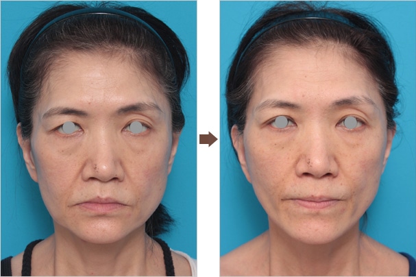 ミニフェイスリフト（頬のたるみ取り）やフェイスリフトは何回でも