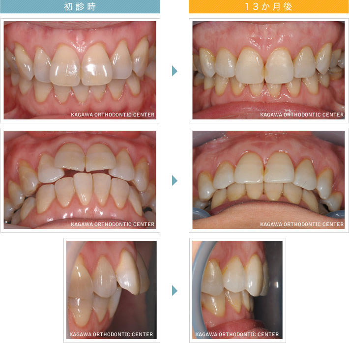 香川県の成人矯正治療はたくま歯科医院まで