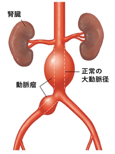 腹部大動脈瘤に対する人工血管置換術、ステントグラフト内挿術｜社会