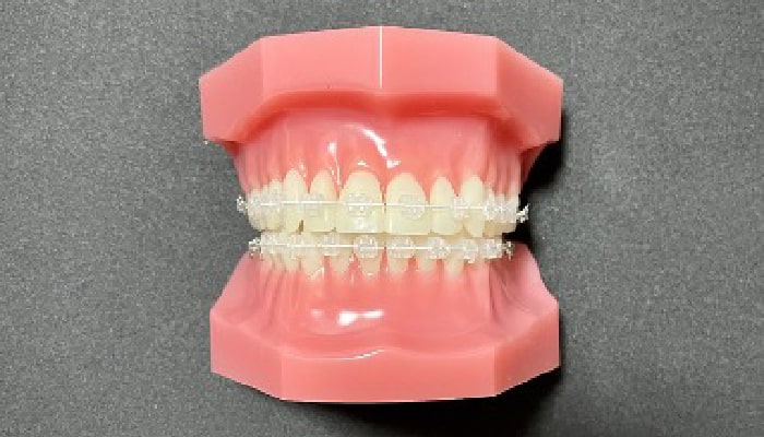 矯正装置紹介｜稲毛駅徒歩3分の矯正歯科｜つみき矯正歯科稲毛