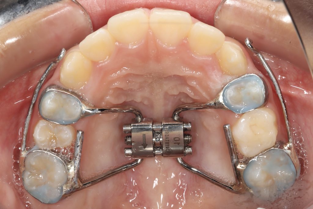 生理的機能咬合を考慮した矯正治療 | ブログ | 羽村市 うすい歯科