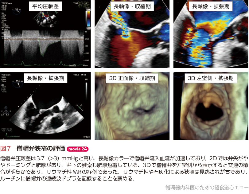 循環器内科医のための経食道心エコー〜基本的な手技から術中・術前の