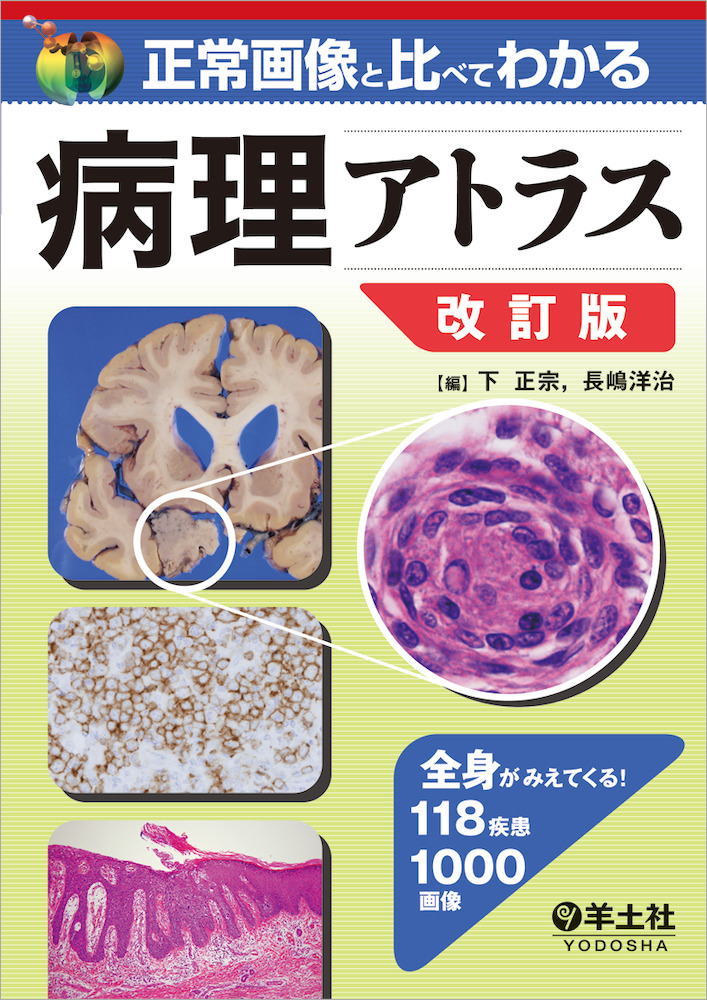 正常画像と比べてわかる 病理アトラス 改訂版〜全身がみえてくる！ 118