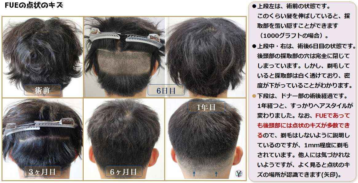 植毛術・参考症例集・FUE｜大阪梅田の自毛植毛・Dr Yamamoto hair