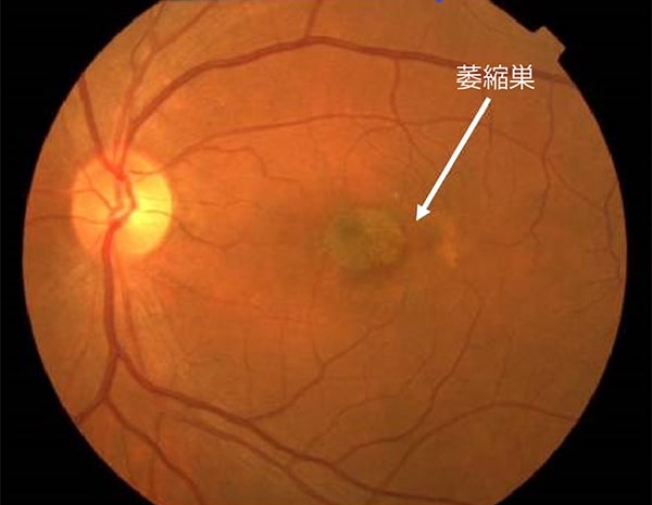 加齢黄斑変性｜さいたま市岩槻区の眼科｜やながわ眼科｜岩槻駅1分