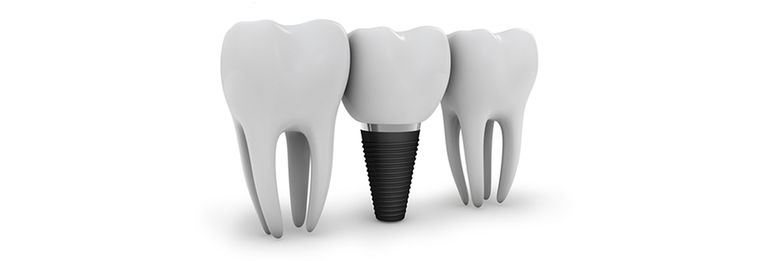 インプラント|大津市の歯医者|ぜぜ歯科医院