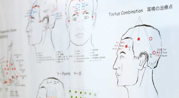 YNSA®YAMAMOTO NEW SCALP ACUPANCTURE – 【はり・灸 松野治療室】大船 栄区