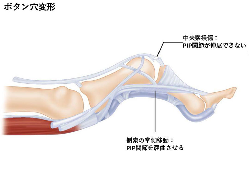 スポーツ外傷／障害｜はっとり整形外科・リウマチ科クリニック
