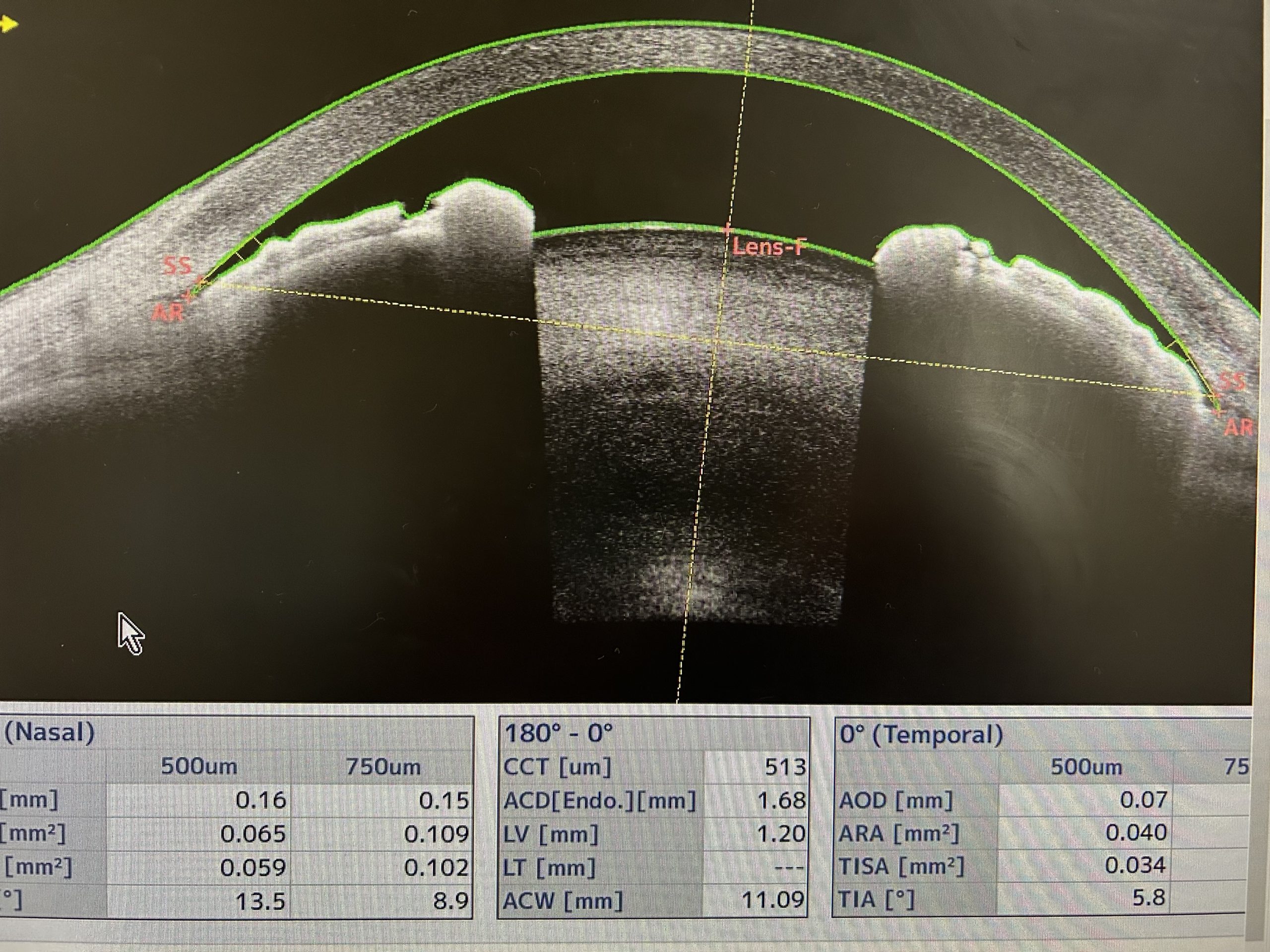眼科コラム｜大津市堅田（かたた）の「ひの眼科クリニック」｜白内障