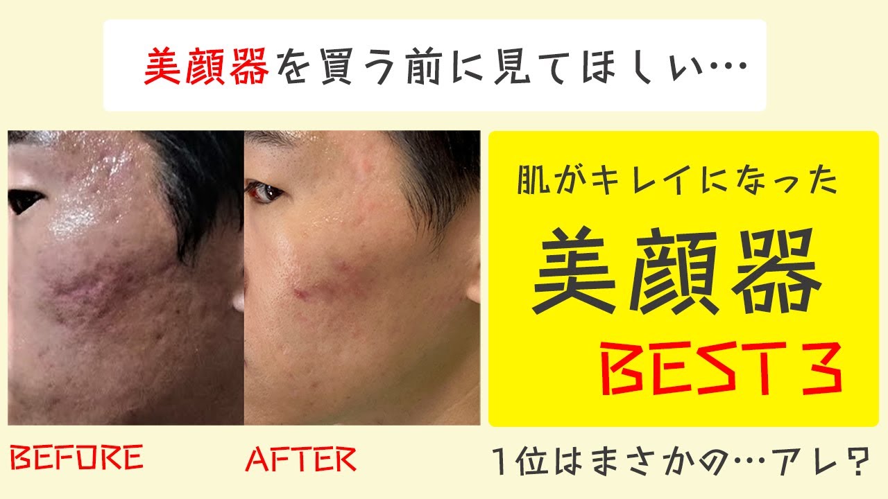 トリア フラクショナルレーザーを2か月使った経過とリアルな美容効果