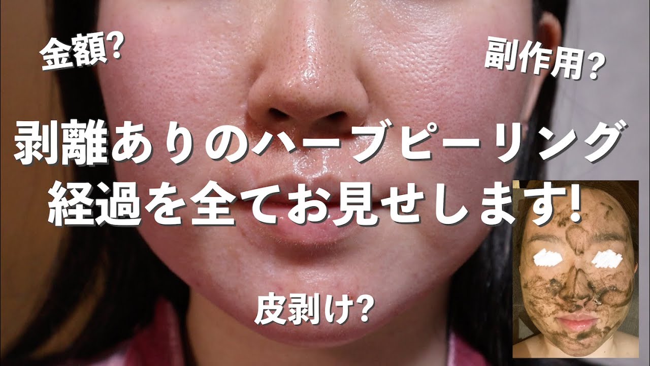 Harbal Peeling Treatment Experience: Cost, Pain, Before and After