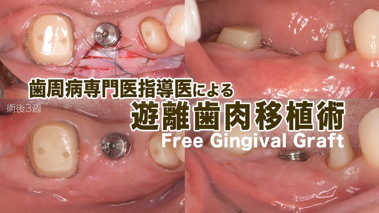 インプラント二次手術 FGG【遊離歯肉移植術】Free Gingival Graft