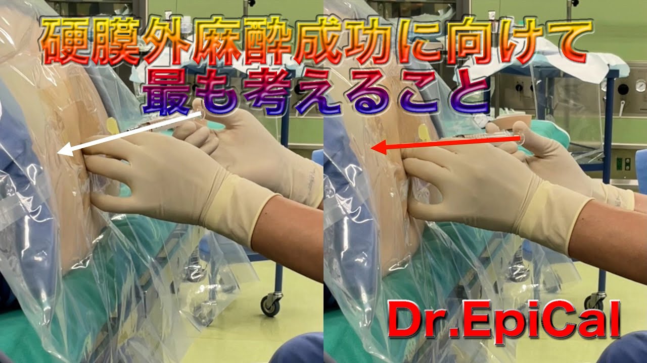 神経ブロック】硬膜外麻酔_Modified Laminar Approach(MLA) - YouTube