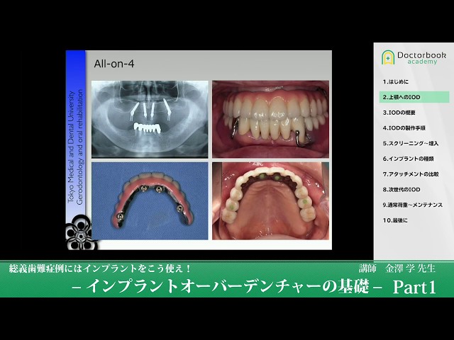 総義歯難症例》インプラントオーバーデンチャーの基礎 #1【金澤学先生