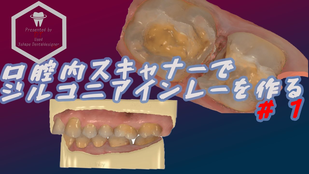 歯科技工】口腔内スキャナーでジルコニアインレーを作る#1 - YouTube