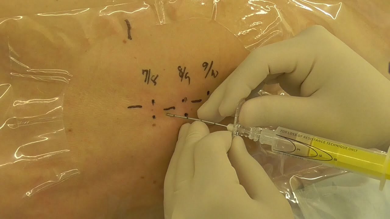 神経ブロック】硬膜外麻酔_Modified Laminar Approach(MLA) - YouTube