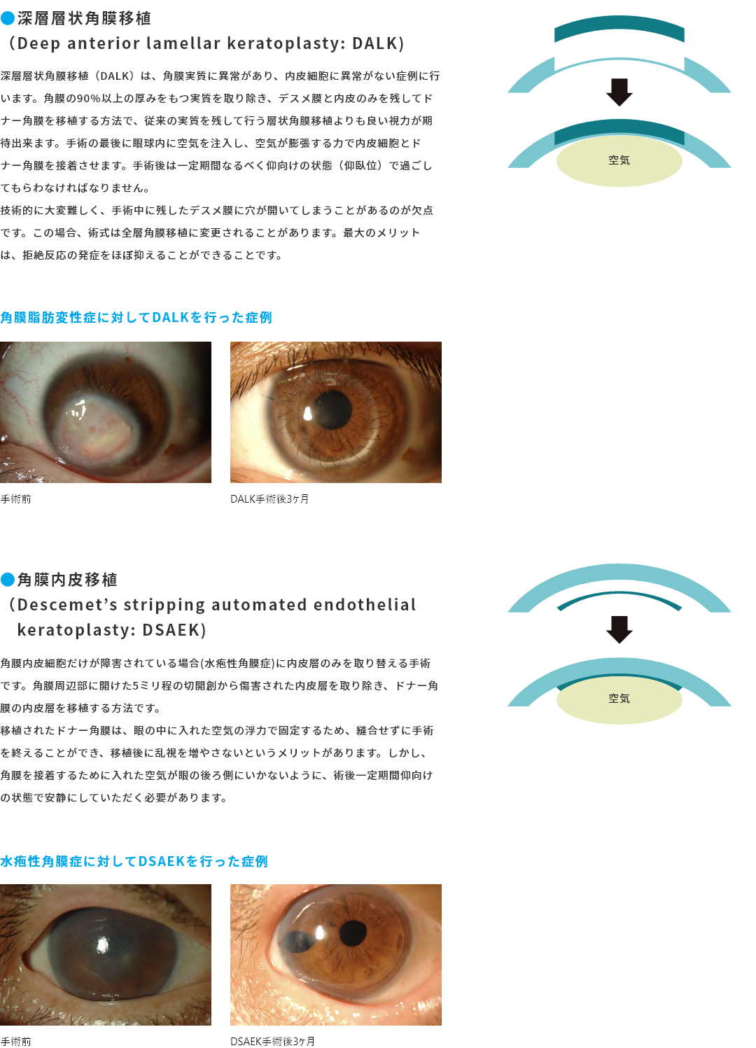 角膜疾患について | いがらし眼科クリニック