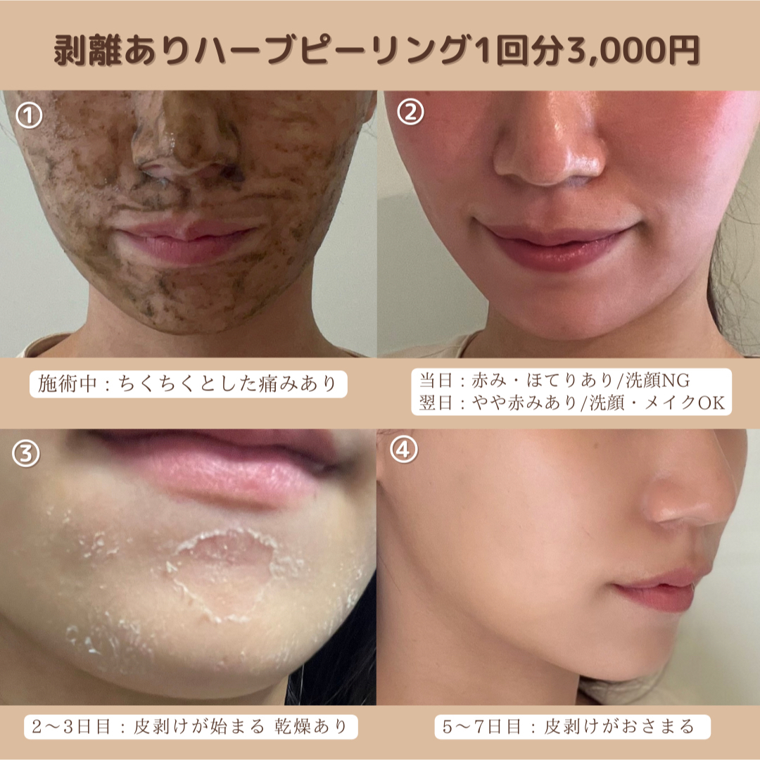 ハーブピーリング 剥離あり 20回分 ローション付き 【公式通販】