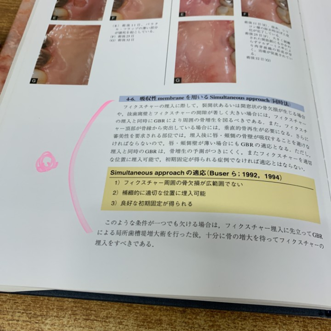 △01)【1点限り!】インプラント周囲のティッシュ・マネージメント/佐藤