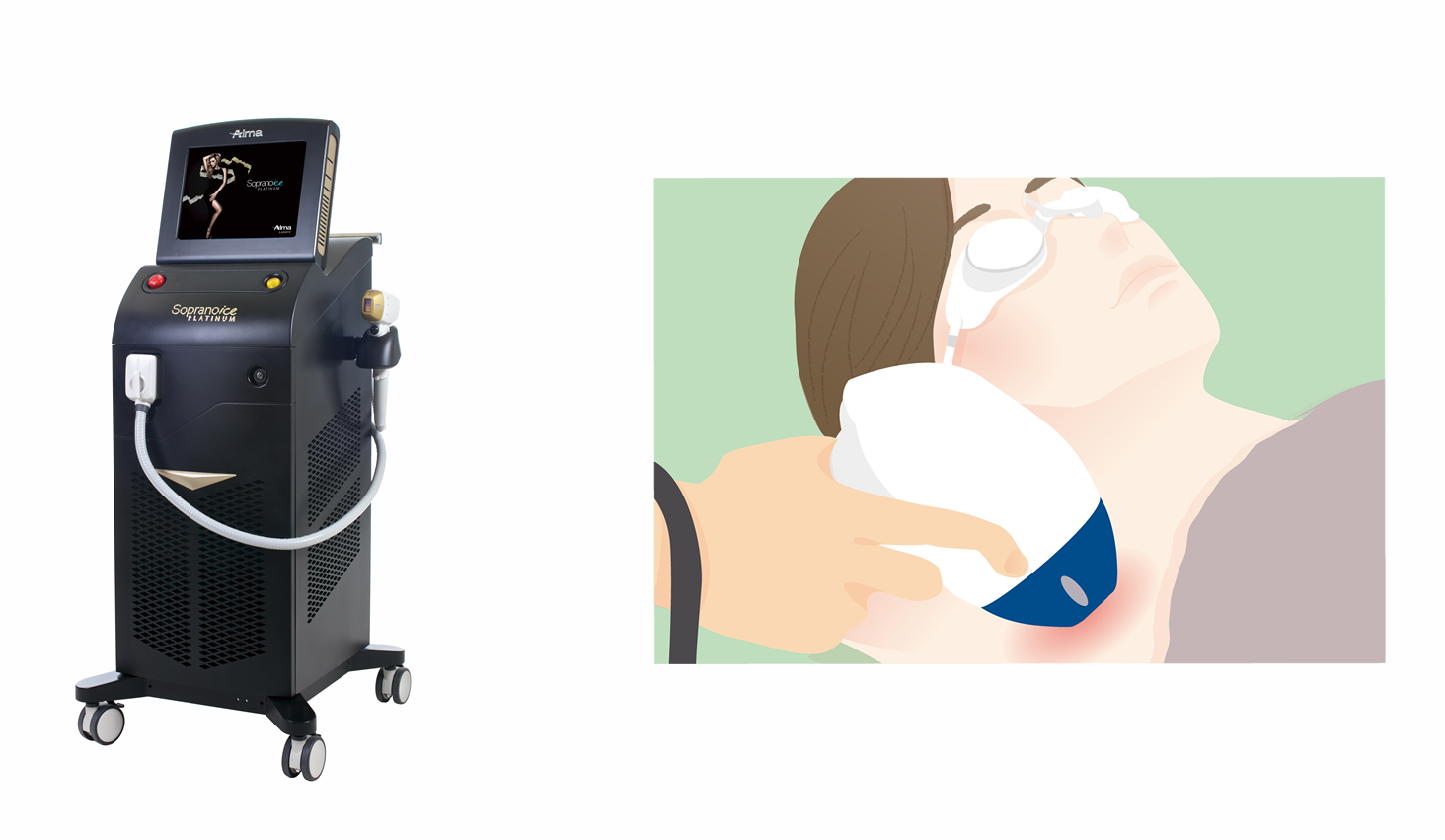 蓄熱脱毛（痛みの少ない脱毛） | | 【川崎の皮膚科】川崎たにぐち皮膚