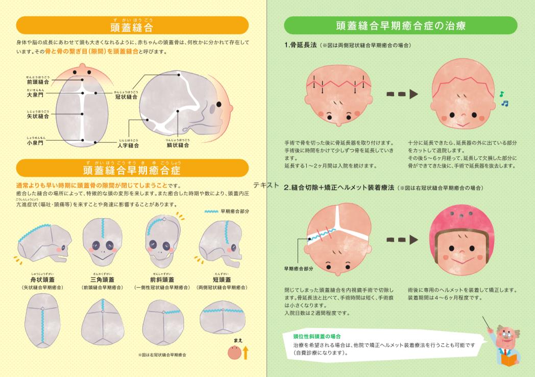 頭蓋縫合早期癒合症