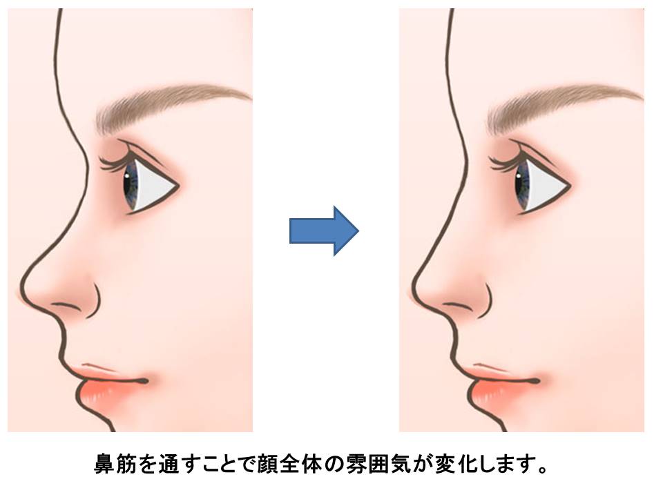 鼻を高くする手術(隆鼻術) | 奈良 樹のひかり形成外科・皮ふ科