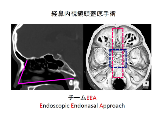 経鼻内視鏡頭蓋底手術（改訂） | KOMPAS – 慶應義塾大学病院 医療