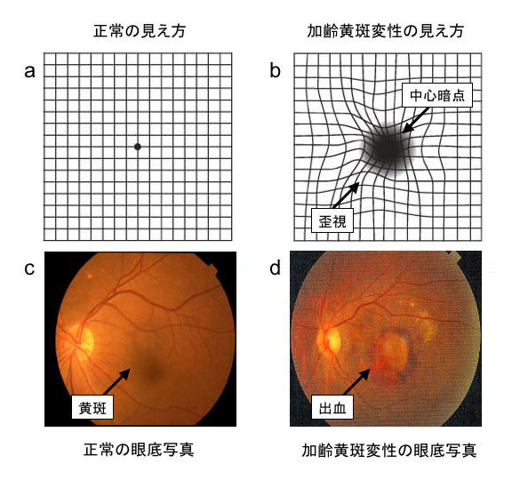 加齢黄斑変性 | KOMPAS – 慶應義塾大学病院 医療・健康情報サイト