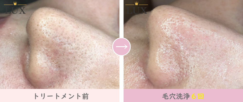 口コミで人気の天王寺シミケアエステサロンMENU ｜シミ専門エステLUX天王寺