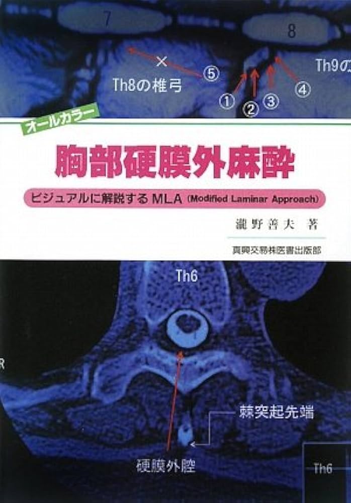 胸部硬膜外麻酔: ビジュアルに解説するMLA(modified laminar approach