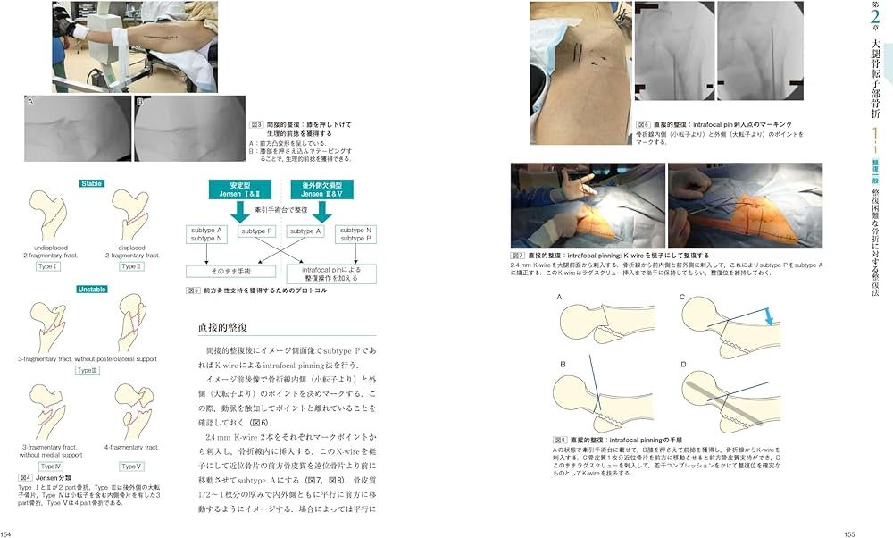大腿骨近位部骨折：大腿骨頚部・転子部・転子下骨折の手術手技 (整形