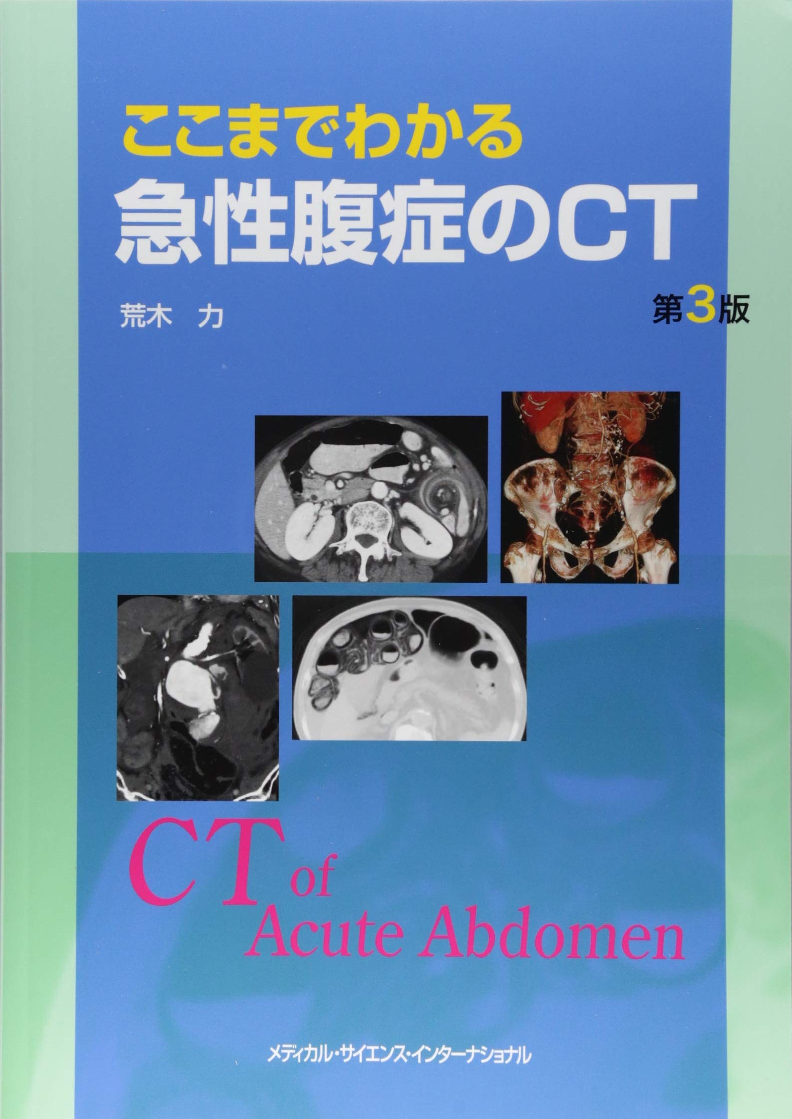 ここまでわかる急性腹症のCT 第3版 | 荒木 力 |本 | 通販 | Amazon