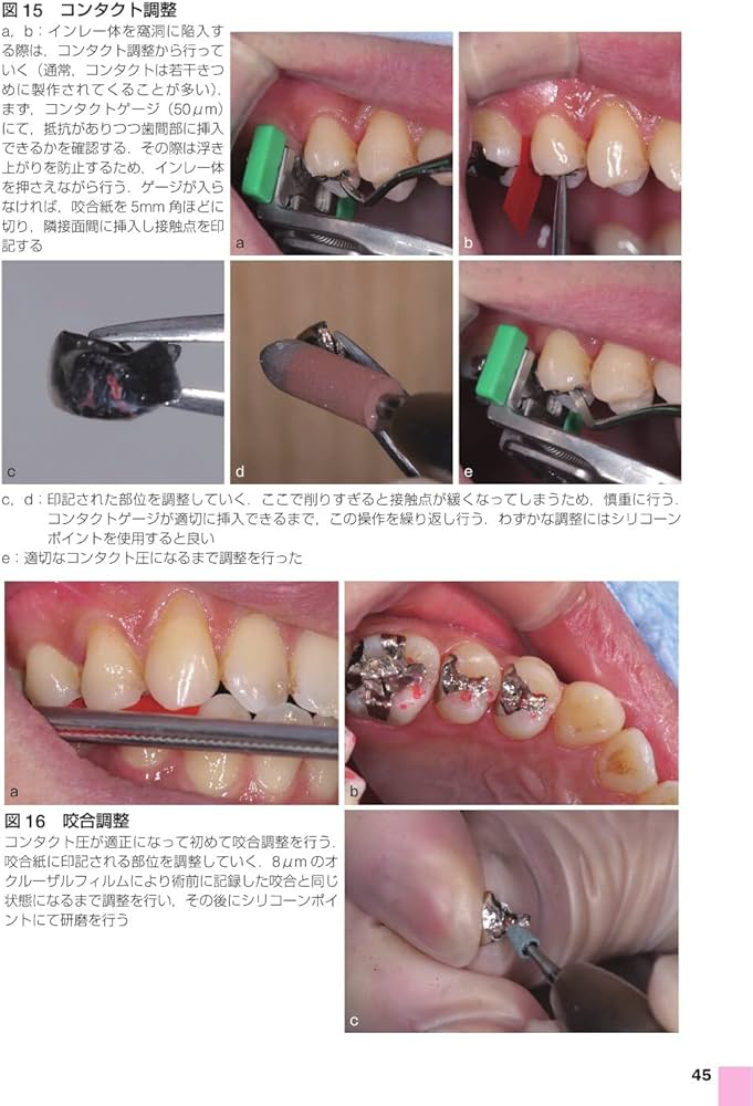 Amazon.co.jp: 歯科臨床まずはここから! う蝕処置: 卒後5年を支える