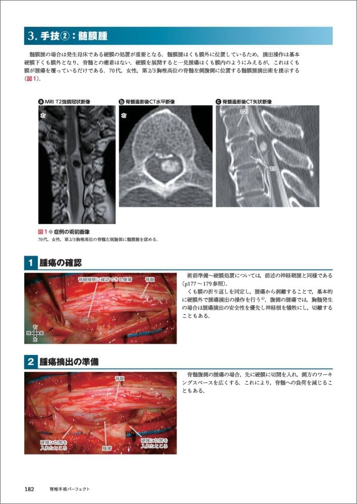 脊椎手術パーフェクト〜術前準備から展開、除圧、固定、閉創まで術中