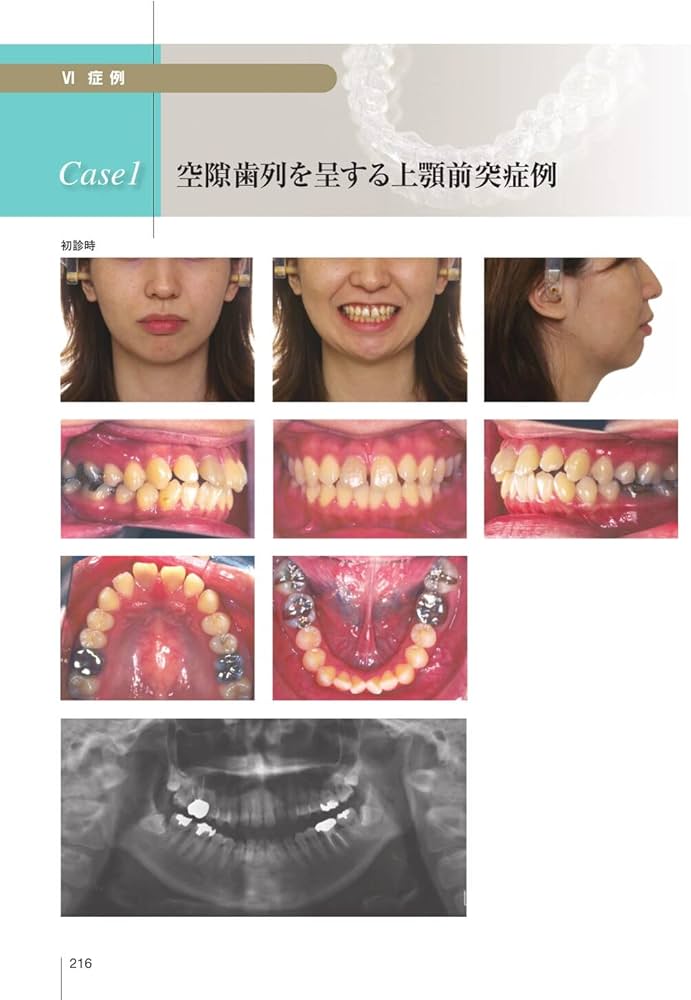 顎顔面のバイオメカニクスとアライナー矯正 | 槇 宏太郎, 高良 有理江