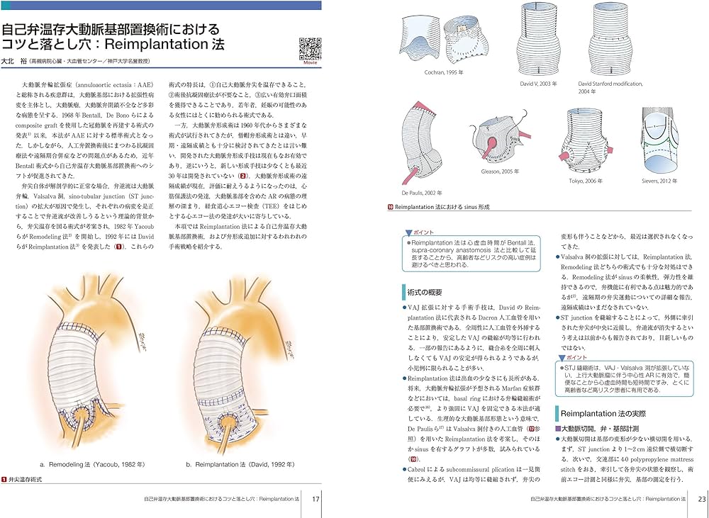 大動脈疾患の手術 (心臓血管外科手術エクセレンス) | 長田信洋, 大北
