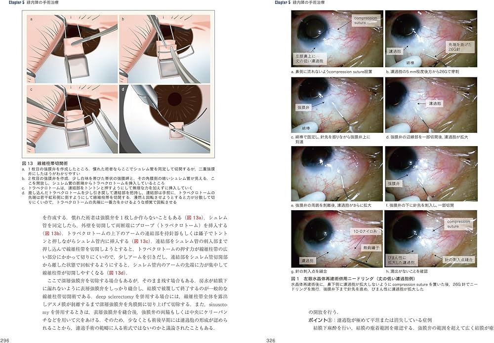 最新 緑内障診療パーフェクトガイドー患者教育から最新の手術治療まで