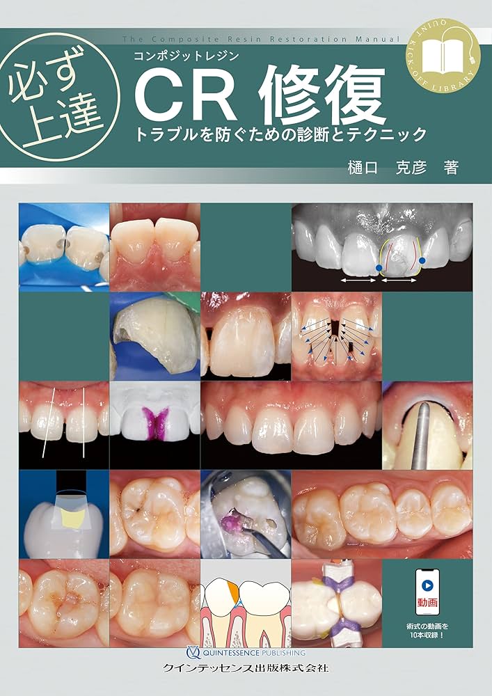 必ず上達 CR(コンポジットレジン)修復: トラブルを防ぐための診断と