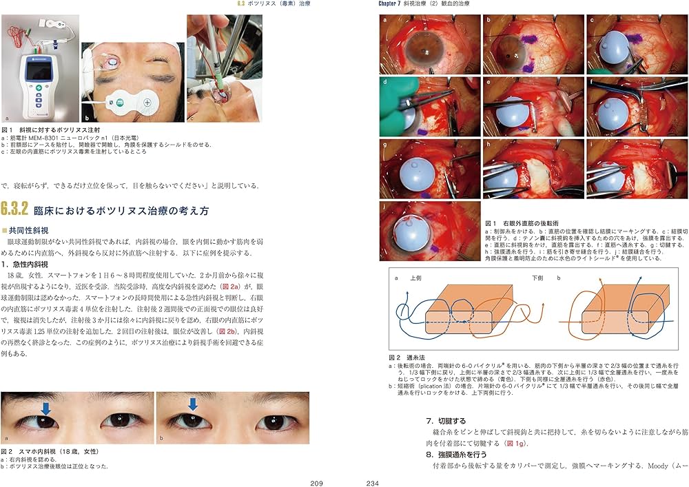 最新 弱視・斜視診療エキスパートガイドー解剖生理・検査法から手術