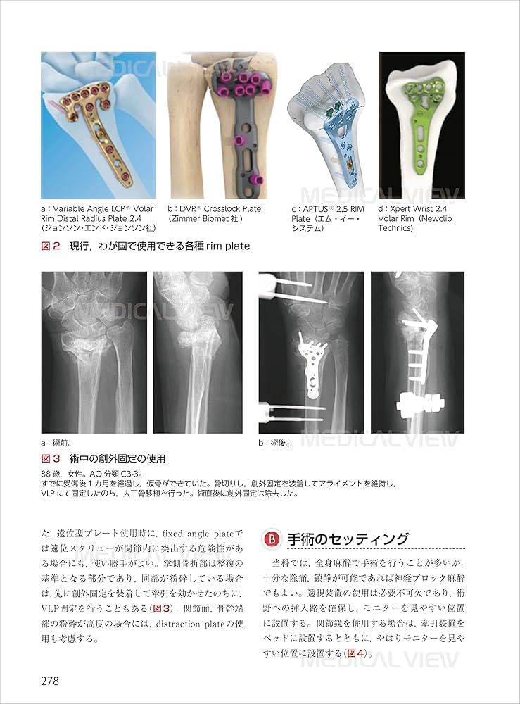 スタンダード骨折手術治療 上肢 | 渡部 欣忍 |本 | 通販 | Amazon